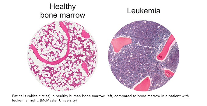 Old drug, new trick: study finds common diabetes drug could help fight leukemia