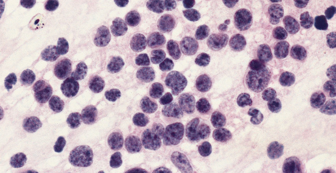 Medulloblastoma cells as seen under a microscope