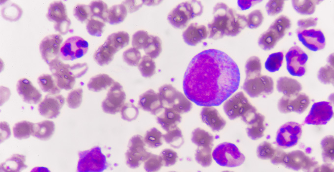 Immature blood cells in leukemia