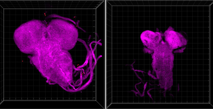 Researchers find a new way to address the challenge of brain tumour “stiffness”