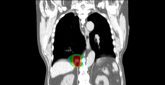 Pan-Canadian radiotherapy group advancing care by reducing barriers to conducting clinical trials