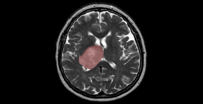 Brain cancer linked to tissue healing, study finds