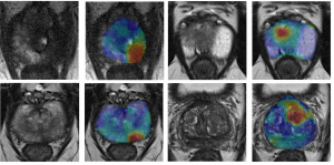Innovative MRI shines new light on cancer