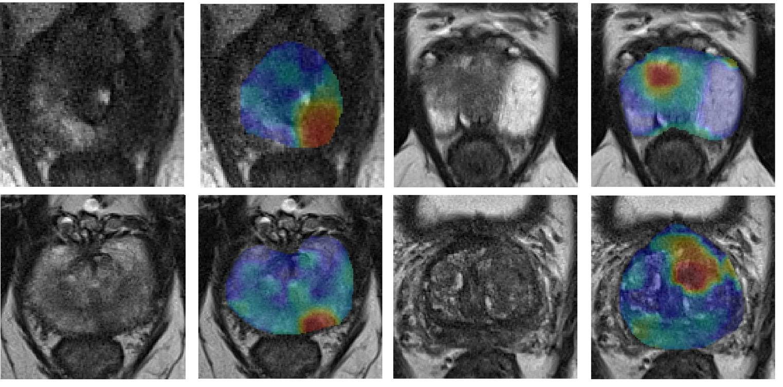 Innovative MRI shines new light on cancer